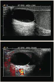 Stand in front of a mirror. Is The Lump On This Teenage Boy S Testicle Malignant Consultant360