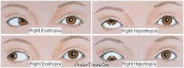 Image result for Eye Deviation