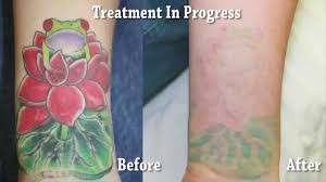 Give us a call and let us know how we can help. Orange County Tattoo Removal Results Youtube