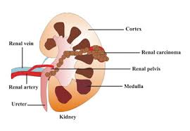 However, when they do occur, the following may happen: Kidney Cancer Awareness Kidney Cancer Awareness