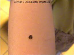 Image result for Spitz Nevus