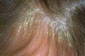 Maybe you would like to learn more about one of these? Bolile Scalpului È™i Tratamentul Acestora Beauty Book Online