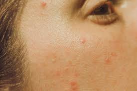 Maybe you would like to learn more about one of these? 6 Tips For Eliminating Pimples On Eyelids