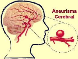 17,544 likes · 17 talking about this. Aneurisma Cerebral Definicion Sintomas Y Tratamientos La Mente Es Maravillosa