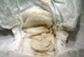 Image result for acholic stools human