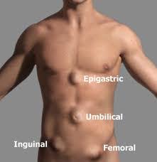 Image result for Inguinal hernia man