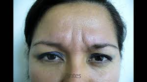 Search anything about wallpaper ideas in this website. Botox Toxina Botulinica Arrugas Lima Peru Cosmedica Peru Dr Condori Youtube