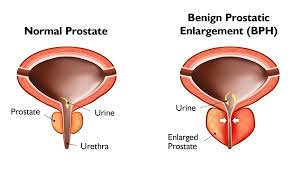 Image result for Expressed Prostatic Secretion
