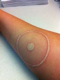 Pin By Venus In Furs On Skin White Ink Tattoos Healed Ink Tattoo Circle Tattoo