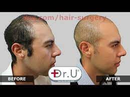 Best Hair Transplant In Los Angeles La Dr Ugraft Bht Fue Hair Restoration Surgeon Dr U Hair Clinic Youtube Severe Hair Loss Hair Loss Body Hair Transplant