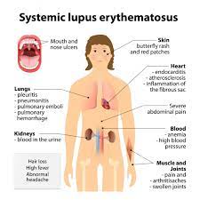 The lupus foundation of america is the largest force in the fight to cure lupus. Lupus Causes Symptoms And Research