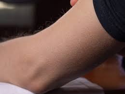See full list on pimplesremedyideas.com Skin Bumps That Look Like Pimples But Aren T