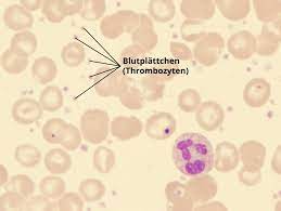 Thrombozyten Zu Hoch Thrombozytose