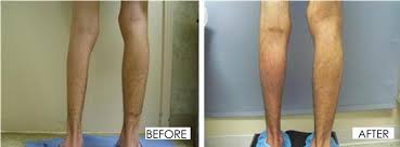 Penile Implant Before And After Pics Erect Erectile Dysfunction Needle Method