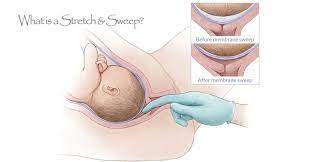 Membrane Sweep Birth In Grampian