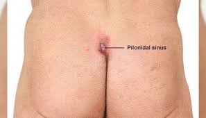 This can also be due to the fact that, one is having naturally curly and coarse hair that can possibly grow back into. Pilonidal Sinus Treatment Op Dr Cetin Altunal