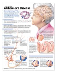 Understanding Alzheimers Disease Anatomical Chart Second Edition