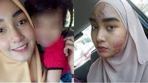 Check spelling or type a new query. Mengerikan Gara Gara Krim Kecantikan Wajah Gadis Cantik Ini Hancur Dan Jerawatan Tribun Sumsel