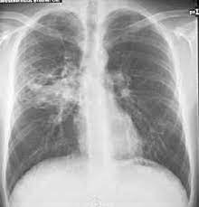 Radiologie Roentgen Diagnose Lungenkrankheiten Roentgenzeichen Dd Differentialdiagnose Fur Den Handheld In Der Kitteltasche Oder Befundungsmonitor