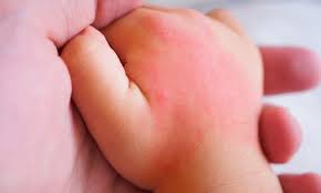 Image result for vyrážka u dětí