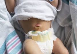 Only give sponge baths do not bathe your baby in a sink or special tub until after the umbilical cord has fallen off. Umbilical Cord Care Guide For Newborns