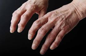 Der begriff arthrose bezeichnet eine degenerative gelenkerkrankung (gelenkabnutzung) und ist nach einer nichtamtlichen definition in deutschland ein „gelenkverschleiß, der das altersübliche maß übersteigt. Arthrose Planete Sante