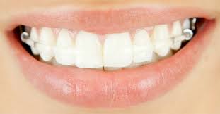 However, they do affect one's speech a fixed retainer is used only when 4 or 6 teeth need to be locked. The Importance Of Retainers Peninsula Orthodontics