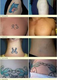 Yes, a permanent tattoo can be removed easily. Regret Your Tattoo We Can Remove Or Cover That Tattoo For You