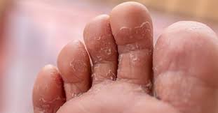 Halo doktor, kenapa kulit kakiku mengupas terus, kan? Kulit Kaki Retak Dan Mengelupas Antara Tanda Kaki Makan Air Ini Antara Cara Ubatinya