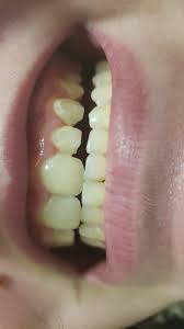 Cavities are among the most common issues in regards to dental care; Just A Warning To You All Be Careful When You Get Your Braces I Had Them For 2 Years And For Most Of It I Was Depressed And Had Trouble Taking Care