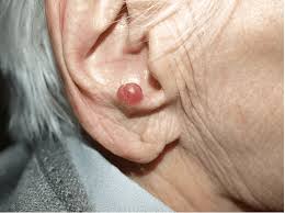 Image result for Merkel Cell Carcinoma