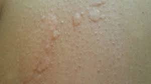 Hives Causes Risks Prevention And Pictures With Images Skin Tag On Eyelid Hives Causes Skin Spots