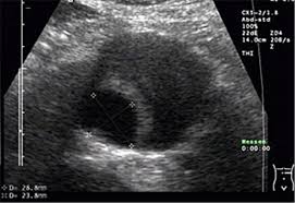 Hallo ihr lieben, wisst ihr ab wann man den ultraschall nicht mehr vaginal macht??? Ultraschall Der Aorta Drei Minuten Die Leben Retten