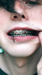 this trend but make it braces 😬 7 months to go
