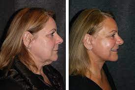 The neck and the lower face are part of a very similar anatomic structure. Lower Facelift New York Lower Facelift And Necklift