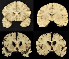 The two associations made the request after the death of english football player jeff astle in 2002. Cte Study Finds Evidence Of Brain Disease In 110 Out Of 111 Former Nfl Players