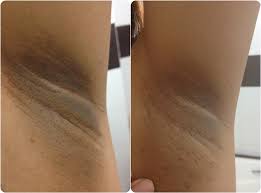 Ada banyak sebab mengapa ia berubah warna antaranya penggunaan deodoran yang tidak sesuai dengan kulit. 3 Petua Putihkan Ketiak Yang Berkesan Hitam Kasi Cerah