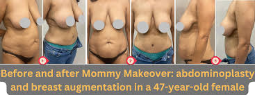 Image result for Breast Augmentation