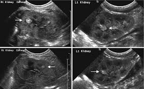 Fig 12 1 Acute Pyelonephritis In The Upper Pole Of The Left Kidney Of A 5 Week Old Male With Urosepsis A Diagnostic Medical Sonography Sonography Ultrasound