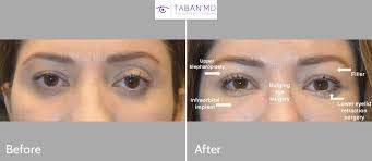 I've been drawing on cat eyes since i was 13, and as every year passes i've noticed. Before And After Canthoplasty Photos Mehryar Ray Taban Md