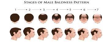 How much does a hair transplant cost? What Is The Hair Transplant Cost In India Regrow Hair Clinic