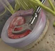 Transforaminal Lumbar Interbody Fusion (TLIF) | Kirkland ...