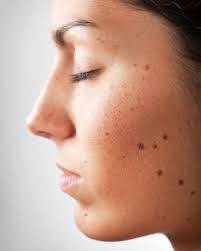 There are several ways to remove moles using natural ingredients around you. How To Remove Moles Using Home Remedies Foreign Policy