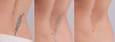 It was a paying customers experience. With Laser Tattoo Removal Business In America