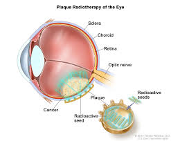 It usually affects the uvea, which is the layer between the retina and the white of the eye. Intraocular Uveal Melanoma Treatment Pdq Patient Version National Cancer Institute