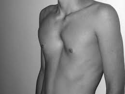 Pectus excavatum is a congenital chest wall deformity that is caused by growth abnormality of the cartilage that connects the ribs to the breastbone (sternum). Upper Pectus Carinatum Download Scientific Diagram