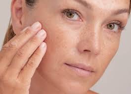 Pigment and Brown Spots Treatment in Wake Forest, NC