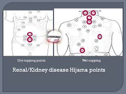 Renal Kidney Hijama Points Hijama Points Hijama Cupping Points