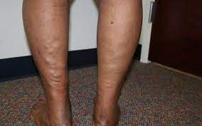 How To Deal With Leg Cramps Vein Specialists Of The Carolinas
