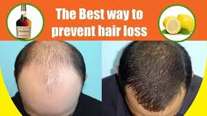 Hair loss, otherwise known as alopecia, can be a very inconvenient and unwanted condition in both men and women. Which Is The Best Hair Oil To Prevent Hair Loss Quora